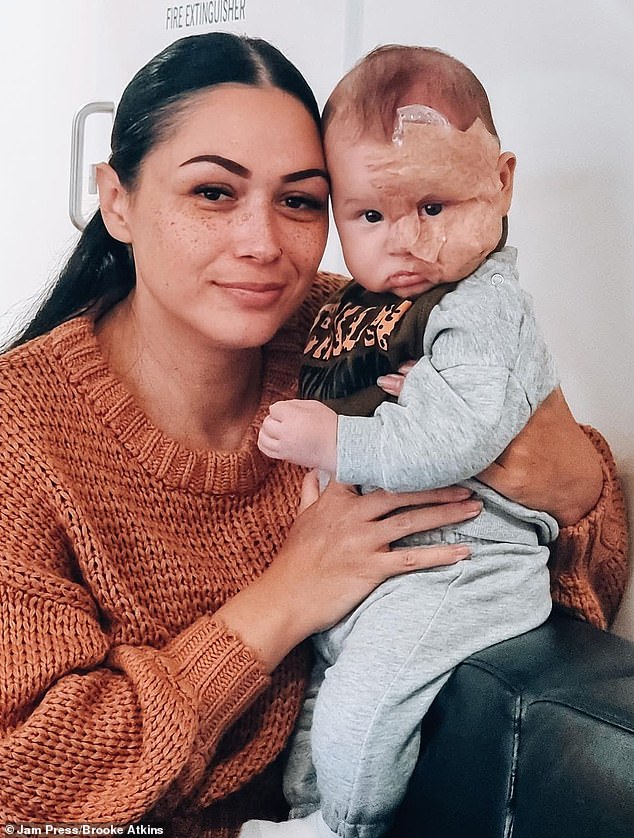 Mother Brooke (pictured) was fiercely criticised after using the treatment on Kingsley (pictured) - but she says his health has improved as a result