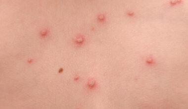 Northern Ireland to introduce free chickenpox vaccination for children from 2026