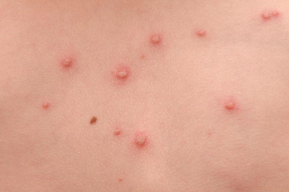 Northern Ireland to introduce free chickenpox vaccination for children from 2026