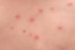 Chickenpox on skin