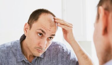 It's estimated that around a quarter of men in their 20s now show signs of balding ¿ by the age of 50, that figure rises to 85 per cent of men