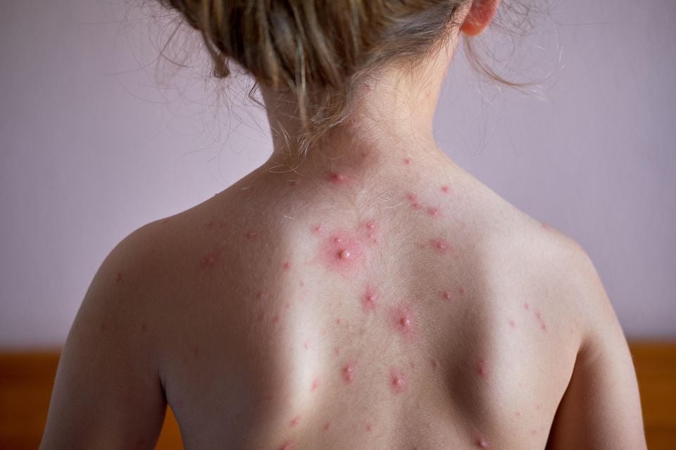 Little girl with chickenpox on her back (Alamy/PA)