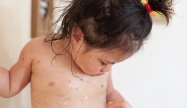 Free chickenpox vaccination to be offered to children in England from January