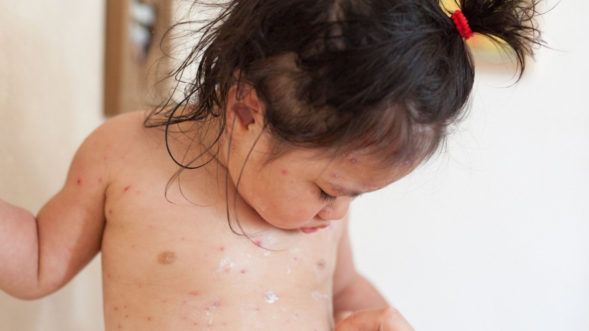 Free chickenpox vaccination to be offered to children in England from January