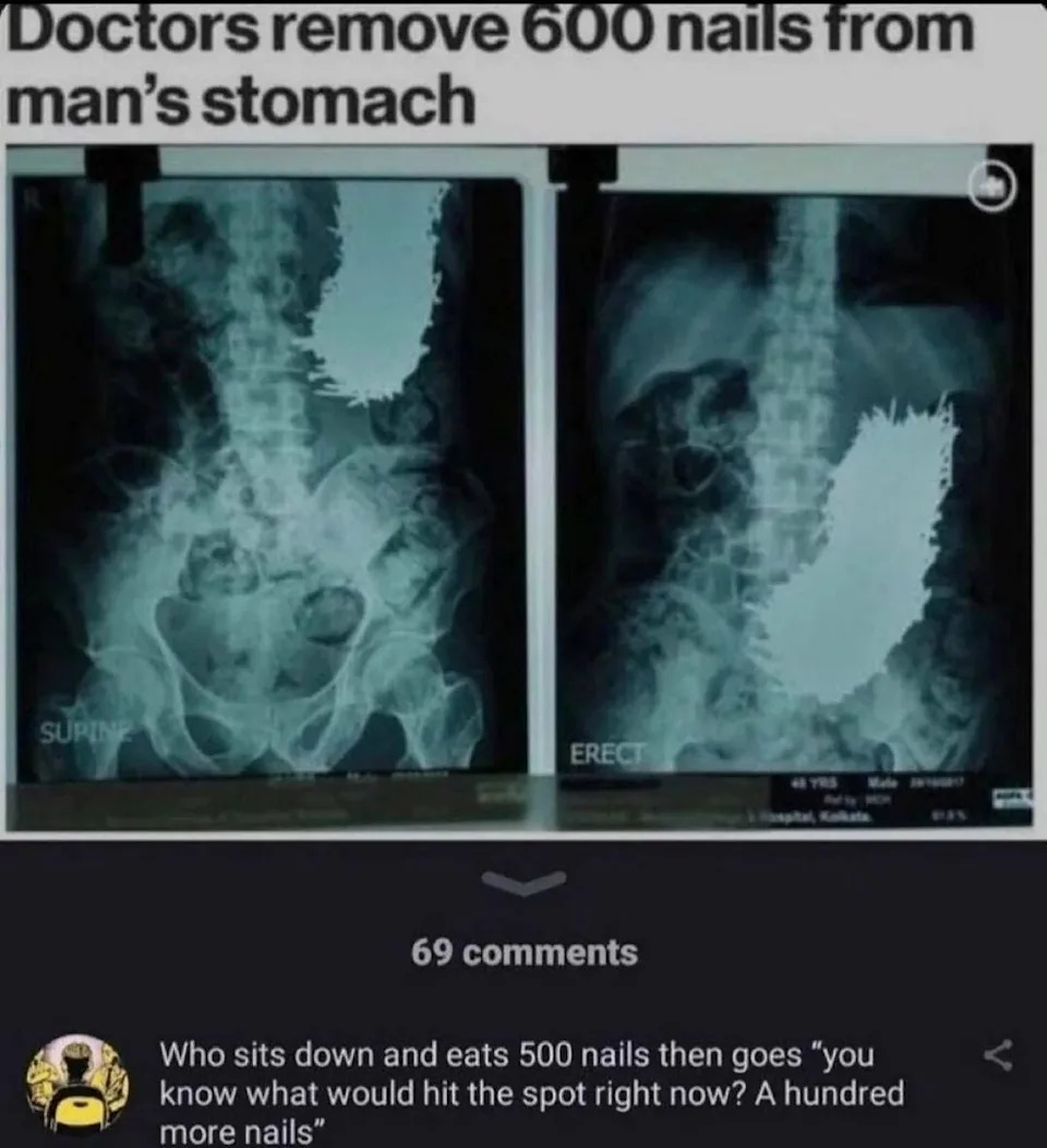 X-ray images show hundreds of nails in a man's stomach. A comment below humorously asks who thought eating 500 nails wasn’t enough