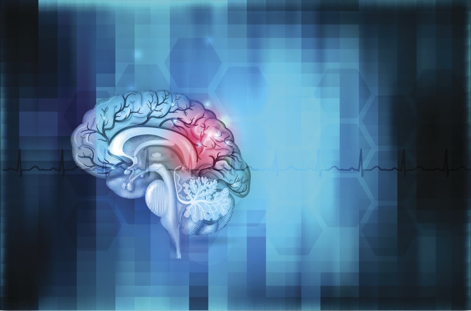 Study Ties Genetics and Common Anticoagulant to Risk of Intracranial Hemorrhage