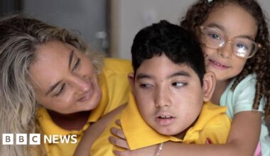 What happened to the babies born with microcephaly?