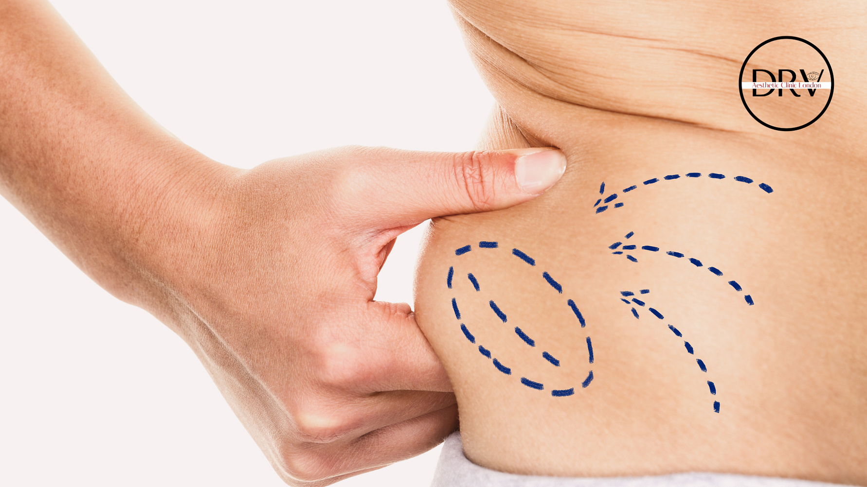 DRV Clinic Redefines Body Contouring in London with Advanced Vaser Liposuction