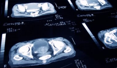 Thousands of men with prostate cancer facing unnecessary overtreatment, experts warn