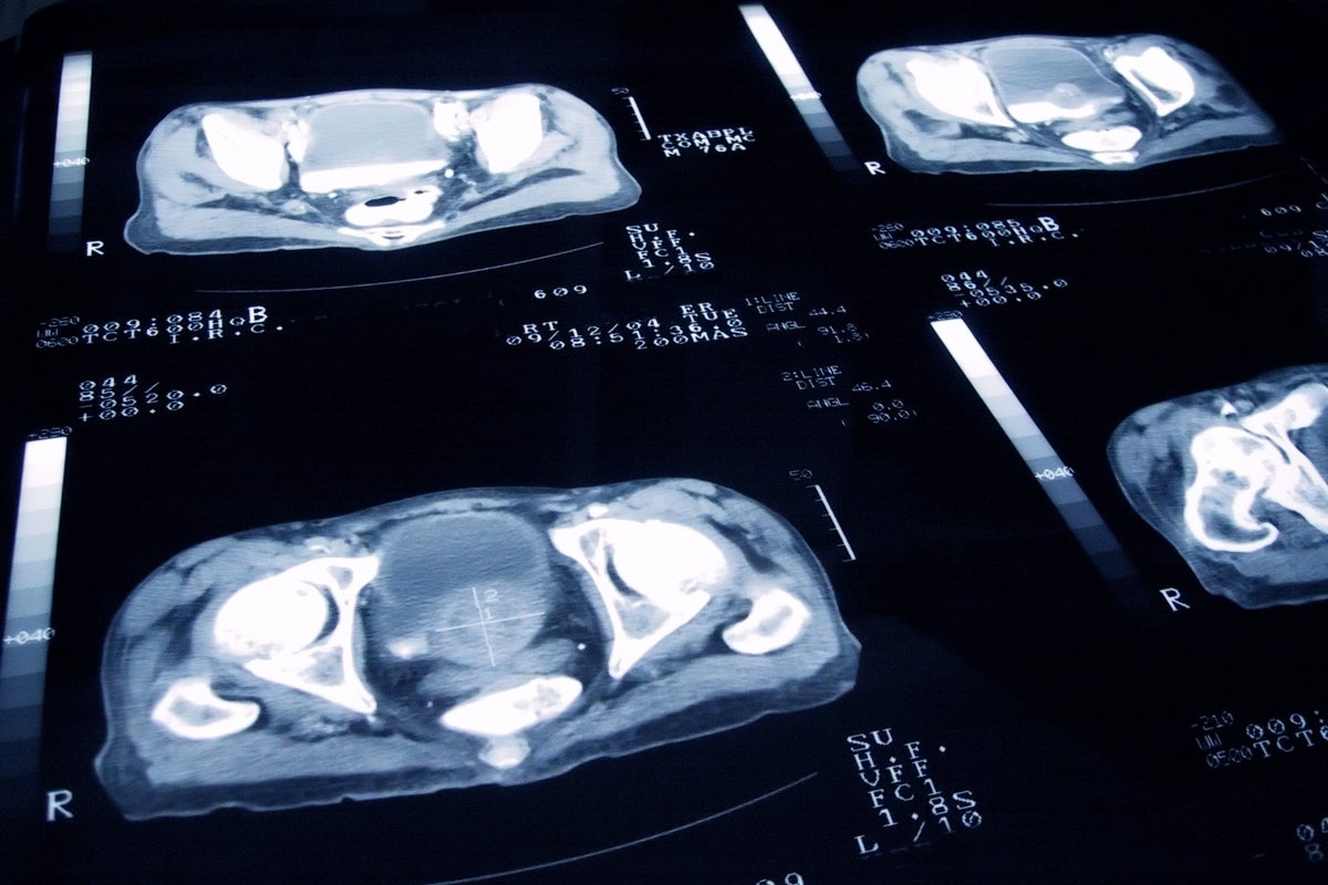 Thousands of men with prostate cancer facing unnecessary overtreatment, experts warn