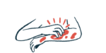 In this illustration, a person is seen in close-up view scratching an itchy rash on their left arm using their right hand.