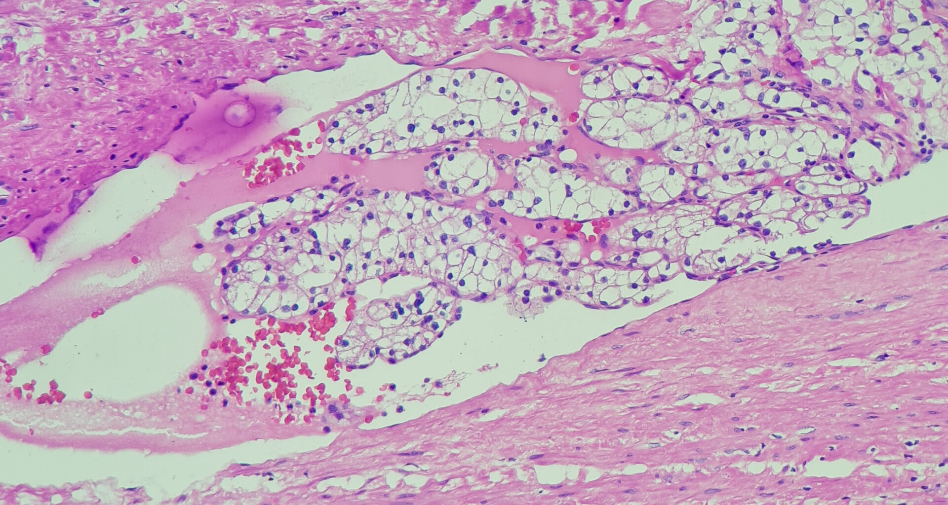 RCC Genetic Testing Key to Avoiding Misdiagnosis of Rare Subtypes
