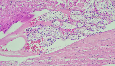 RCC Genetic Testing Key to Avoiding Misdiagnosis of Rare Subtypes