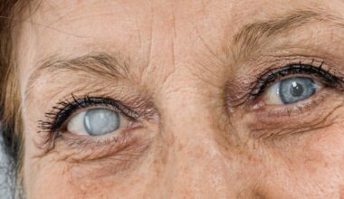 The Centre for Eye Research Australia is studying the genetic background of different cataracts. Image: oz/stock.adobe.com.