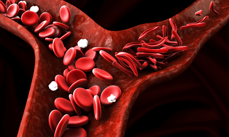 New CRISPR breakthrough could transform sickle cell treatment