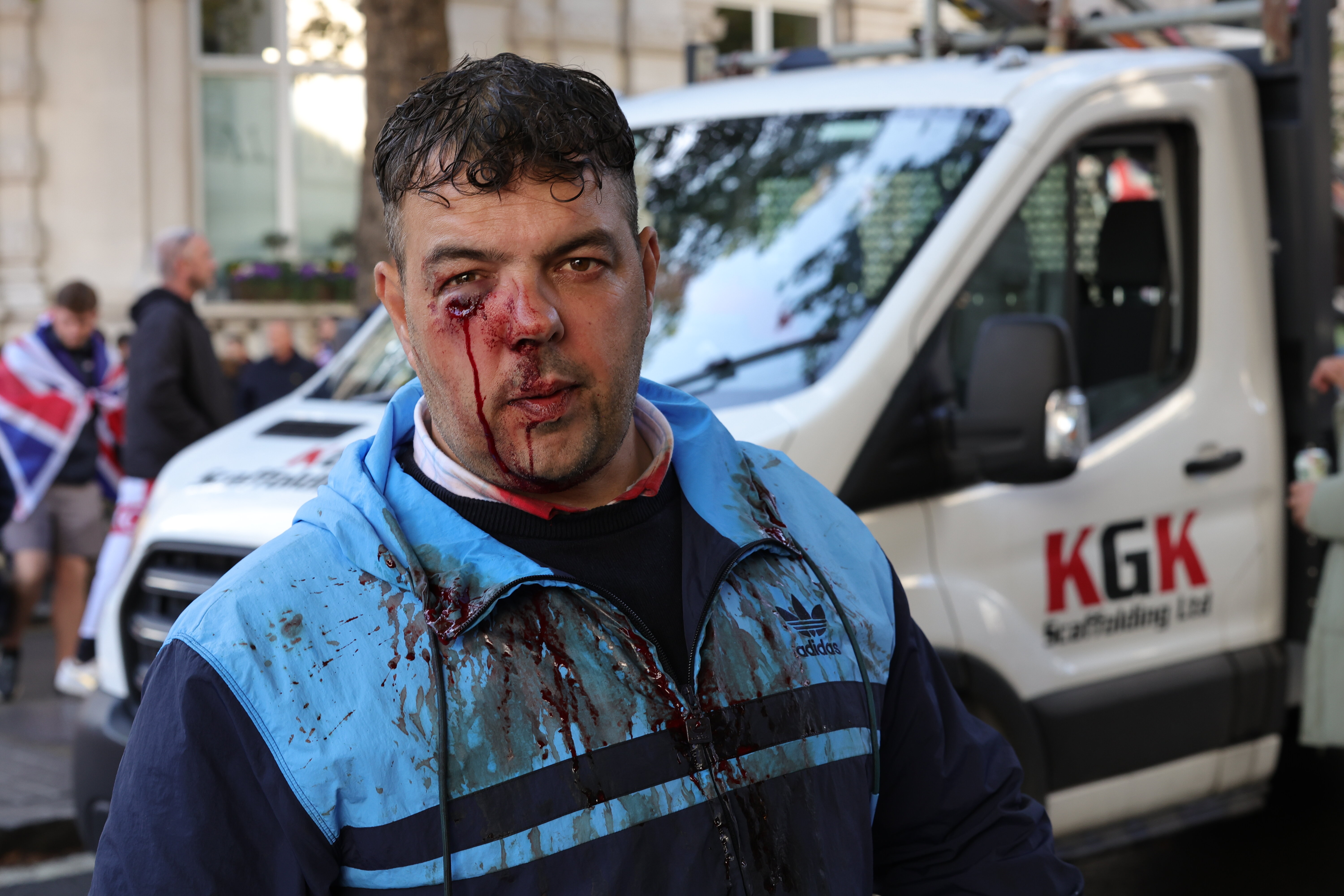 Bloody protester with facial injuries at the Unite the Kingdom protest.