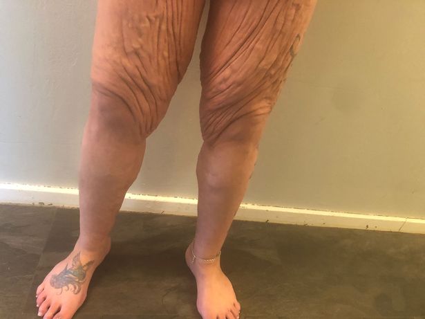 Danni's loose skin on her legs