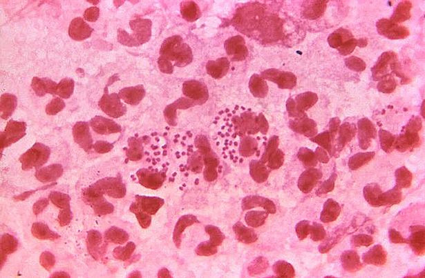 Gonorrhoea bacteria viewed through a microscope