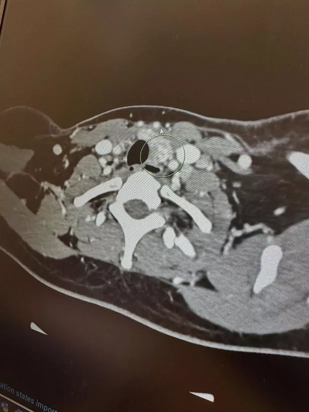 Tameika's CT scan confirming the diagnosis of thyroid cancer (Jam Press)