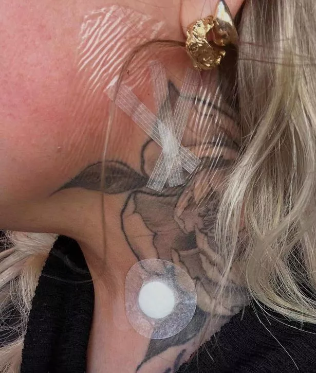 Tameika's neck after her biopsy (Jam Press)