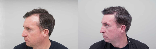 Robbie Fowler has had a second hair transplant