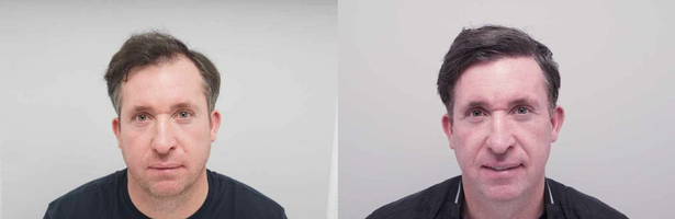 Robbie Fowler has had a second hair transplant