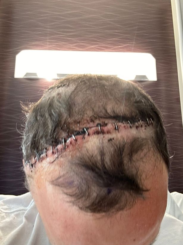 George Wade's surgery scar