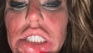 Danielle Mason has claimed she was physically attacked by her ex-fiance Lee Dopson, after  sharing an image of her face alongside videos detailing their legal battles