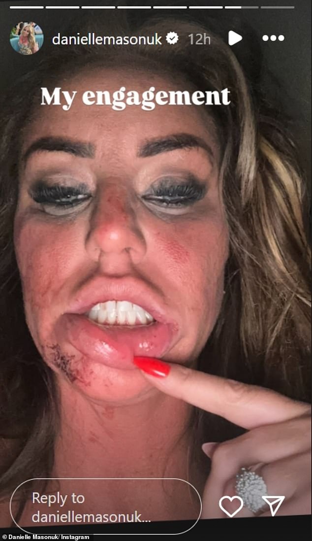 Danielle Mason has claimed she was physically attacked by her ex-fiance Lee Dopson, after  sharing an image of her face alongside videos detailing their legal battles
