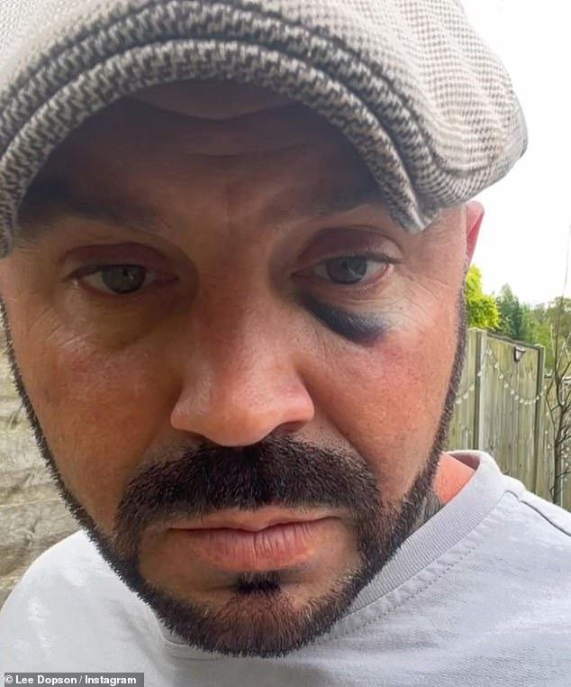 Lee meanwhile posted a video montage of his face with various bruises, which Danielle told the Daily Mail were the result of self-defence amid the attack