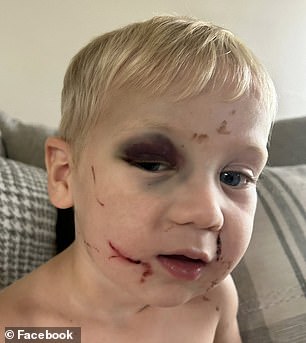 Clay Weeks was left with a black eye and deep scratches on his face and neck following his first day of school at Little Blessings Child Care