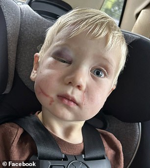 Pictured: Clay's swollen face