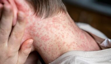 Health authorities have warned residents in parts of NSW to monitor for symptoms after a patient travelled from WA, where an outbreak is ongoing (stock)