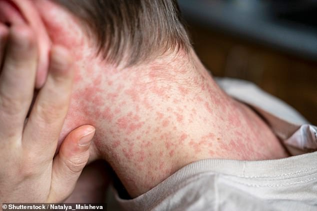 Health authorities have warned residents in parts of NSW to monitor for symptoms after a patient travelled from WA, where an outbreak is ongoing (stock)