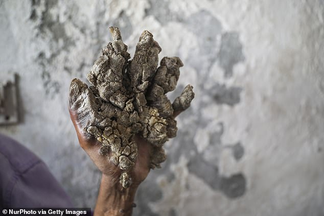Dubbed tree man syndrome the people who have the skin disorder suffer from wart-like growths that resemble tree bark all over their bodies
