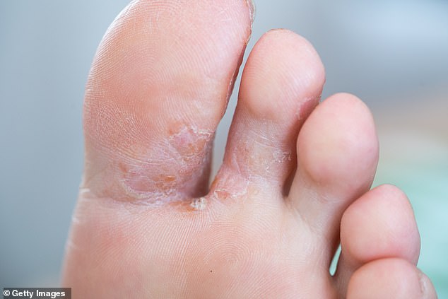Athlete’s foot is a common fungal infection that thrives in warm, damp skin – especially if you don’t dry properly between your toes