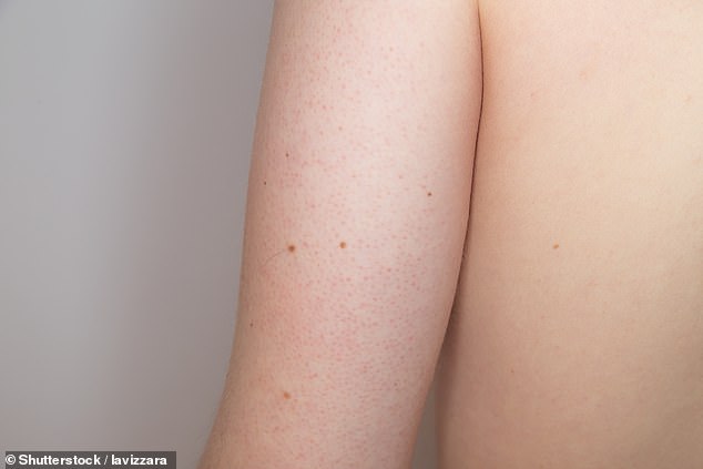 Keratosis pilaris affects more than four in ten adults and is caused by a build-up of keratin, a protein in the skin
