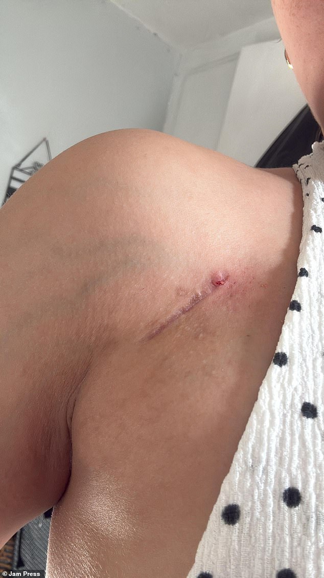 The treatments and tests have left Ms Kalkan with scarring just below her right shoulder