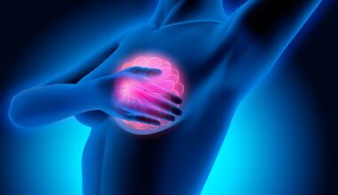An estimated 40 per cent of women successfully treated for primary breast cancer retain traces of these inert ‘sleeper cells’ when they go into remission