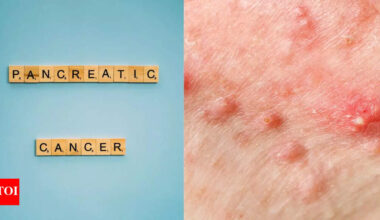 Pancreatic symptoms on skin: Early signs you shouldn’t ignore |