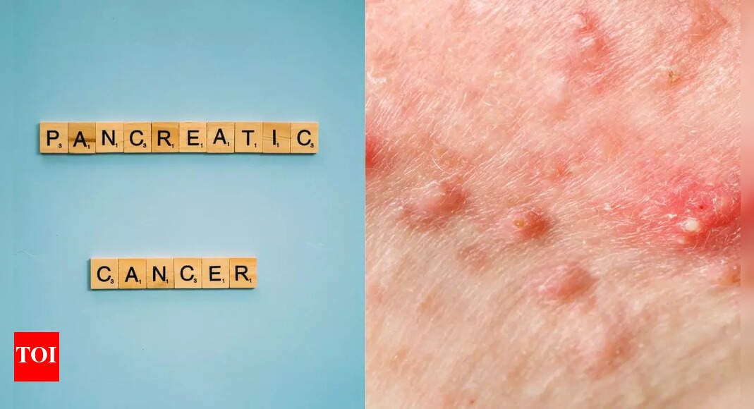 Pancreatic symptoms on skin: Early signs you shouldn’t ignore |