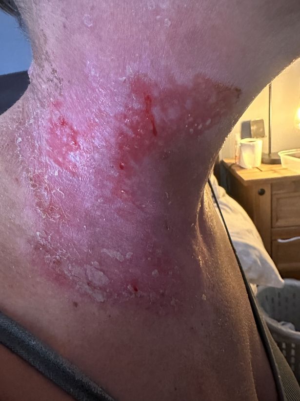 Leanne's red, sore neck