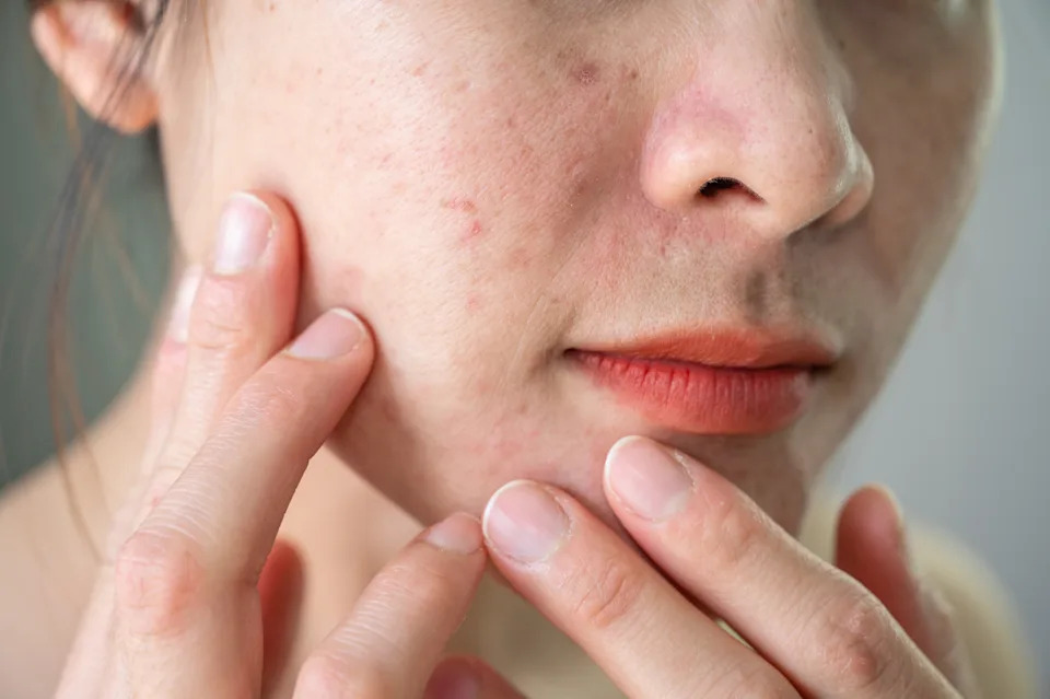 Wrinkles are folds or creases that appear on the face and body as the skin loses elasticity and the amount of collagen.