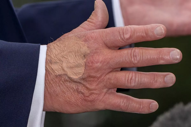 Patch seen on Trump's hand before he boarded Air Force One earlier today