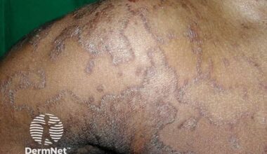 Genetic Study Yields Personalized Therapeutics for a Rare Skin Disorder