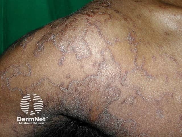 Genetic Study Yields Personalized Therapeutics for a Rare Skin Disorder