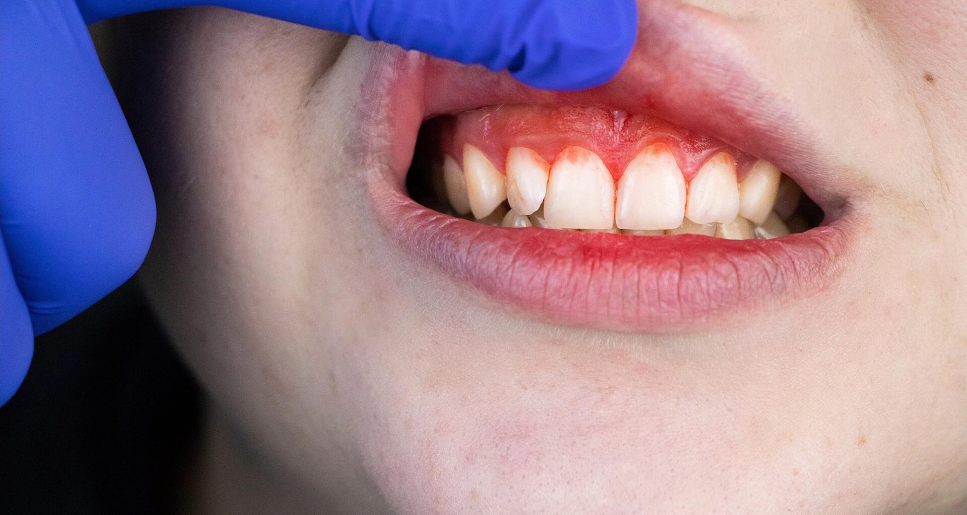 Bleeding Gums Gum Disease