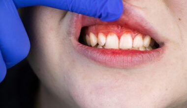 Bleeding Gums Gum Disease