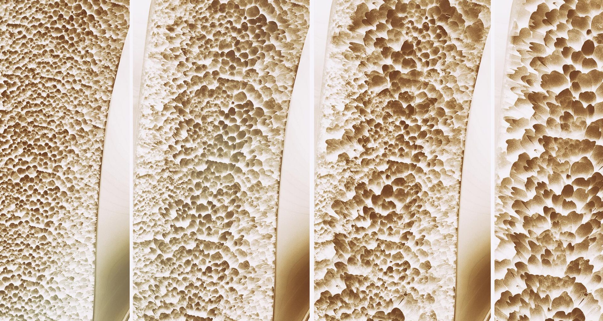Bone Strength Osteoporosis Stages