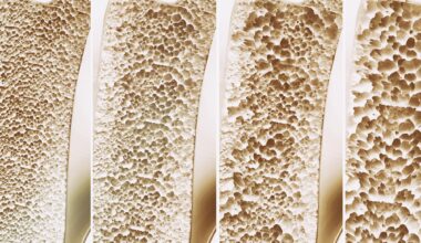 Bone Strength Osteoporosis Stages